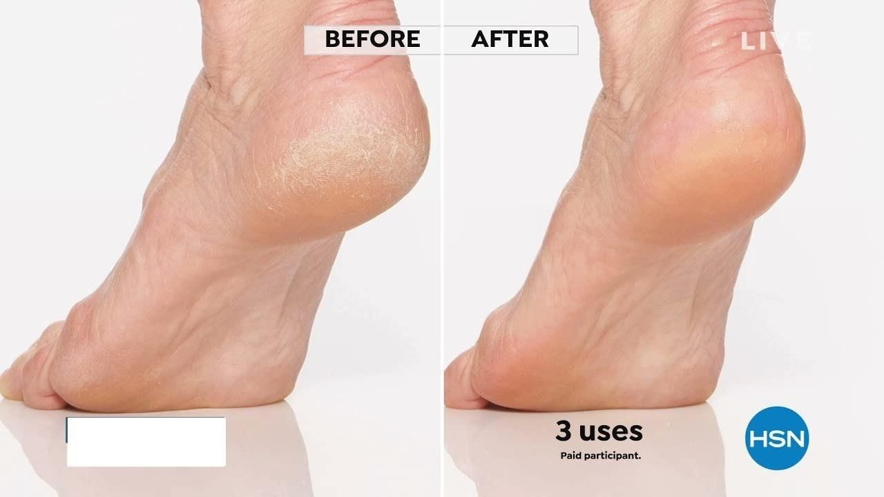 Flawless PediPen ( Salon-At-Home)